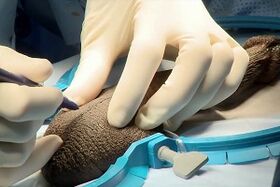 the incision of the surgical enlargement of the penis